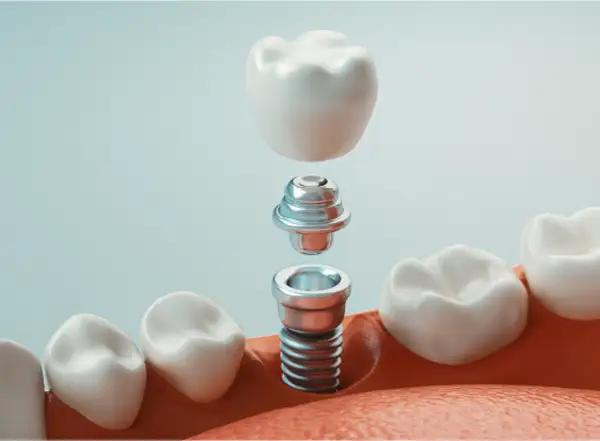 Dental Crowns & Bridges